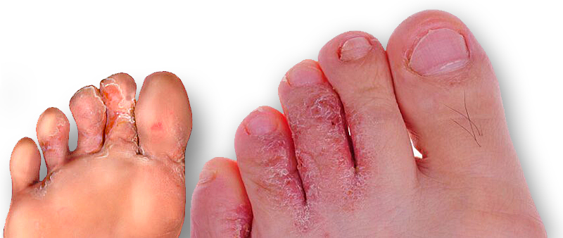 ATHLETE'S FOOT: CAUSES, SYMPTOMS, AND SOLUTIONS | Mya Care