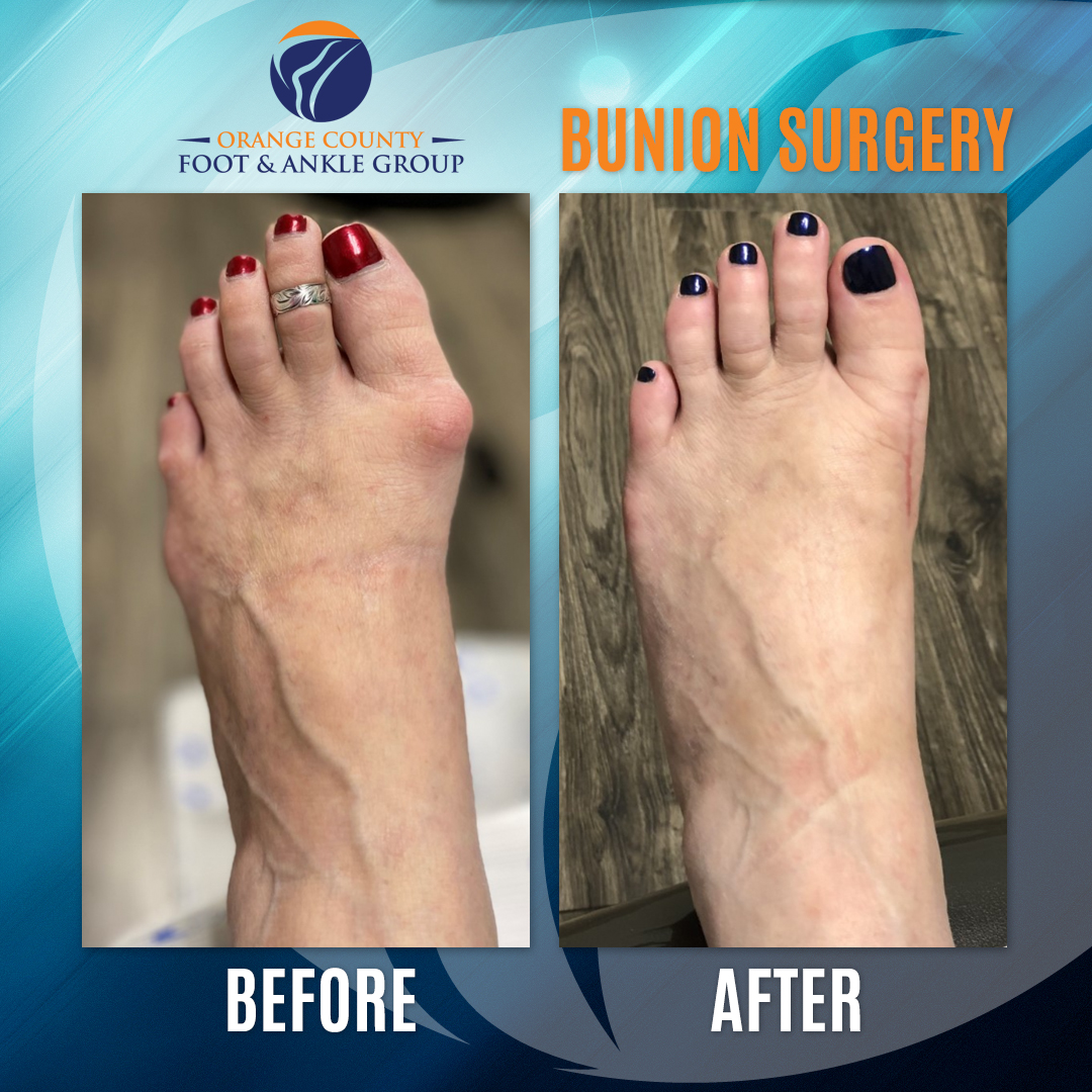 Bunion - BEFORE & AFTER - Bunion Surgery in Orange County - HBfeet.com