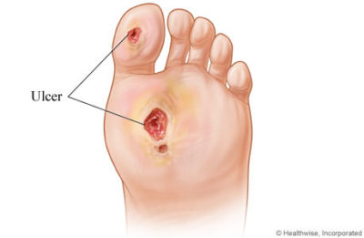 Foot Ulcer illustration