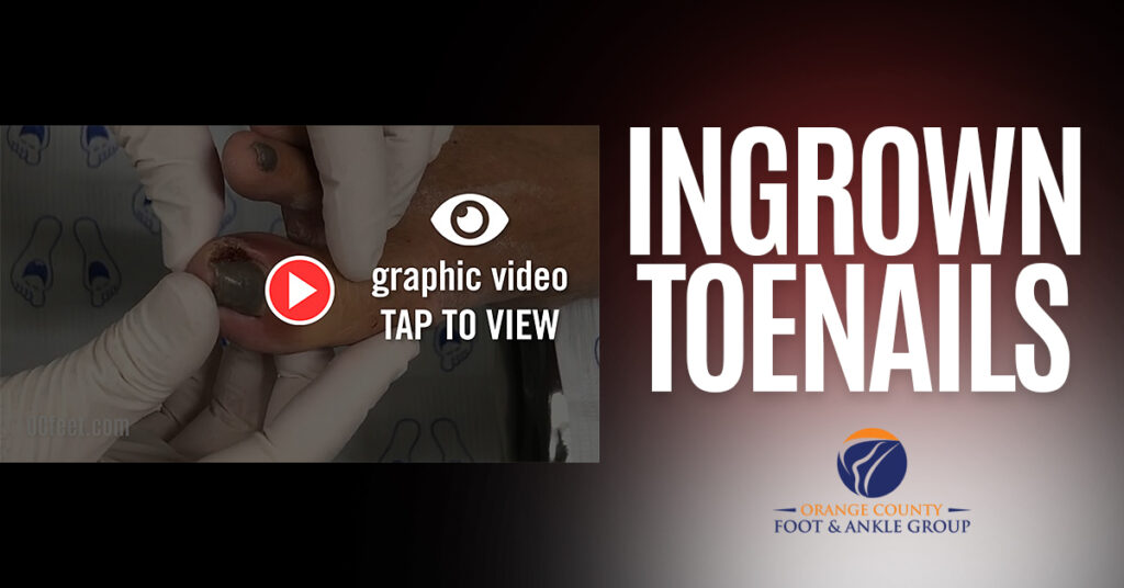 Ingrown Toenail Video - Graphic Video Warning