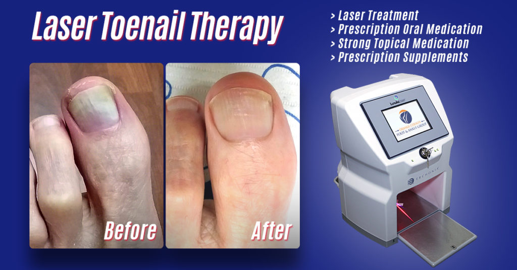 Lunula Cold Laser | Fungal Nail Solutions